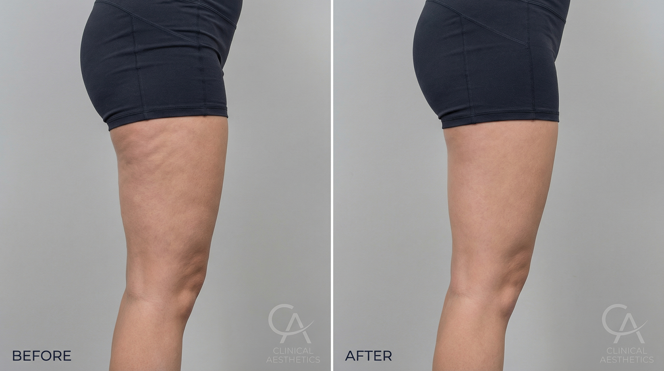 Vorher-Nachher Transformation Oberschenkel