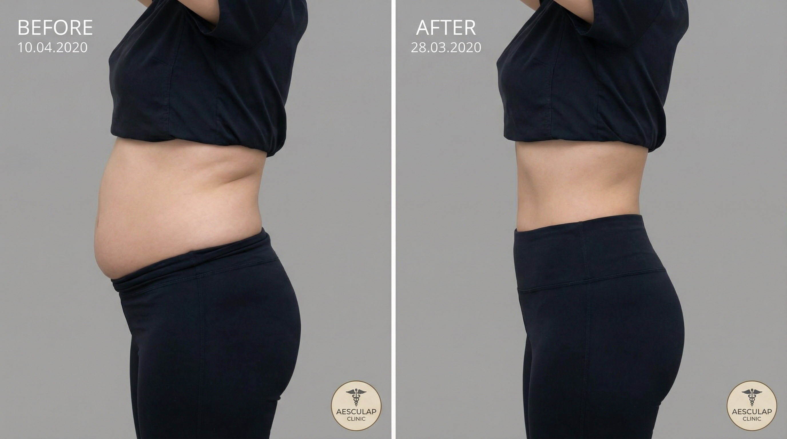 Vorher-Nachher Transformation Bauch